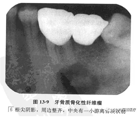 牙骨質骨化性纖維瘤