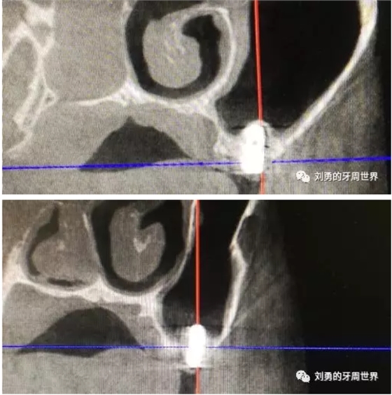 失敗上頜竇種植患者的補救