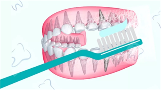 戰(zhàn)“疫”護牙方法：“坐困家中”，誰來救救我的種植牙？