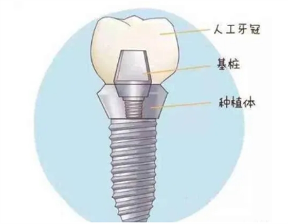 最詳細的種植牙流程