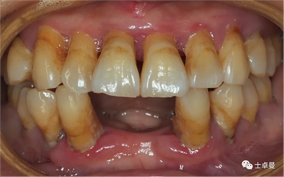 【病例分享】應用全程數字化對牙周炎患者實現全口即刻種植即刻修復