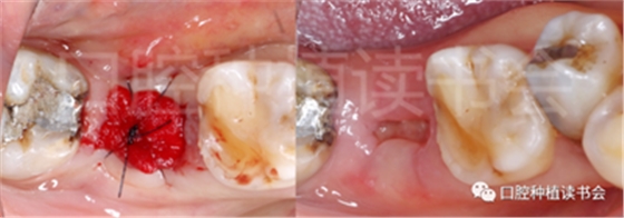 后牙區即刻種植臨床指南