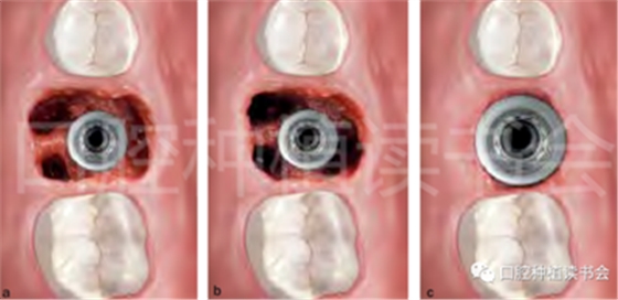 后牙區即刻種植臨床指南