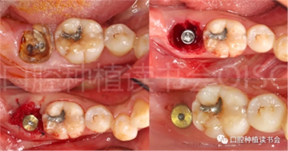 后牙區即刻種植臨床指南