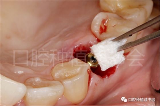 后牙區即刻種植臨床指南