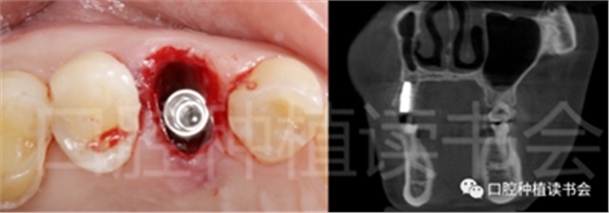 后牙區即刻種植臨床指南