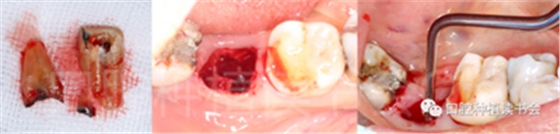 后牙區即刻種植臨床指南