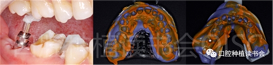 后牙區即刻種植臨床指南