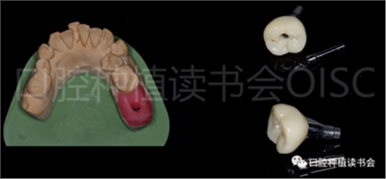 后牙區即刻種植臨床指南