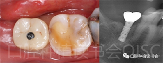 后牙區即刻種植臨床指南
