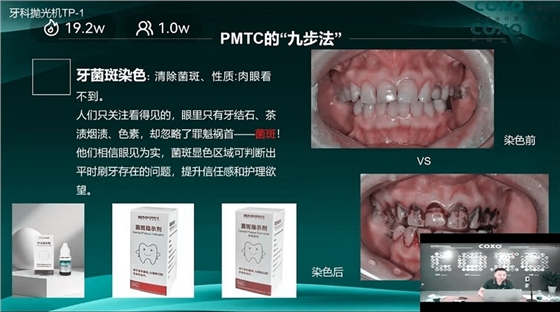 牙菌斑染色