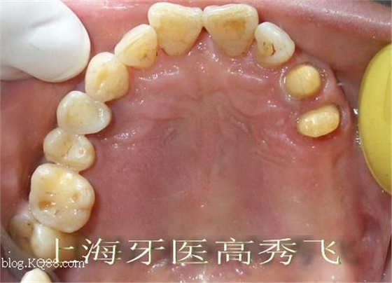 圖解后牙精密附著體修復2例（原創）