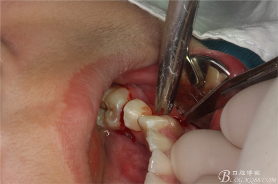 微創法摘除下頜第二前磨牙含牙囊腫