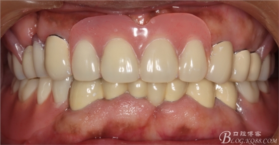 重度牙周炎的咬合重建修復兩年后效果－－塘沽牙醫吳世超