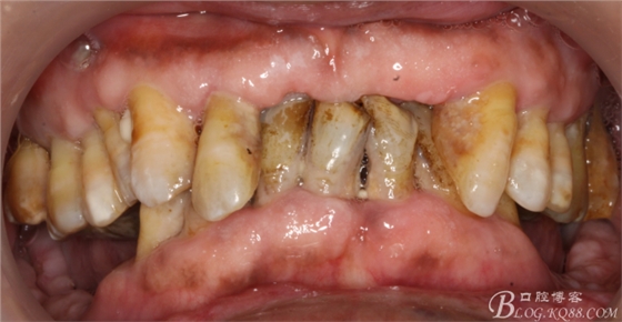 重度牙周炎的咬合重建修復兩年后效果－－塘沽牙醫吳世超