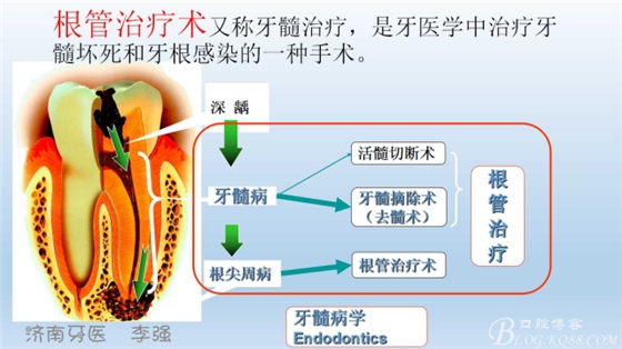 根管再治療，高嵌體即可修復（濟南牙醫~ 李強）