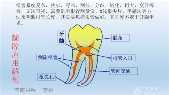 根管再治療，高嵌體即可修復（濟南牙醫~ 李強）