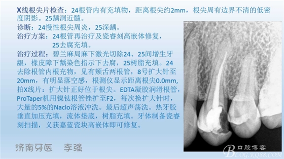 根管再治療，高嵌體即可修復（濟南牙醫~ 李強）