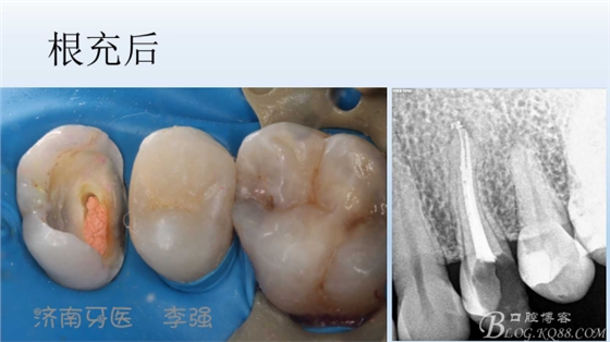 根管再治療，高嵌體即可修復（濟南牙醫~ 李強）