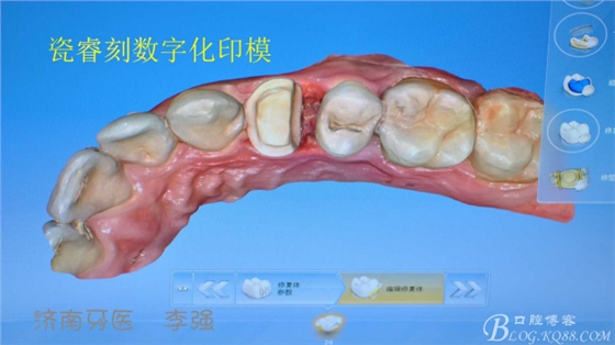 根管再治療，高嵌體即可修復（濟南牙醫~ 李強）