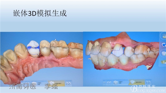 根管再治療，高嵌體即可修復（濟南牙醫~ 李強）