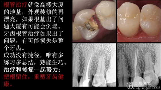 根管再治療，高嵌體即可修復（濟南牙醫~ 李強）