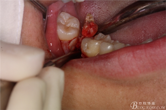 雙側下頜第二磨牙阻生牙的微創拔除