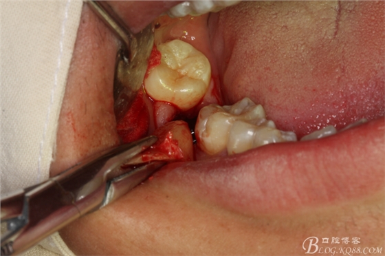 雙側下頜第二磨牙阻生牙的微創拔除