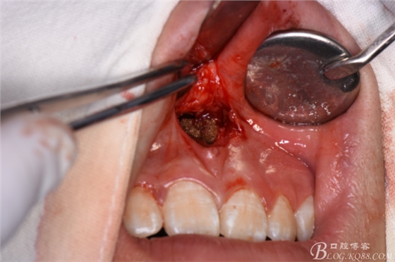 雙切口拔除鼻底埋伏多生牙