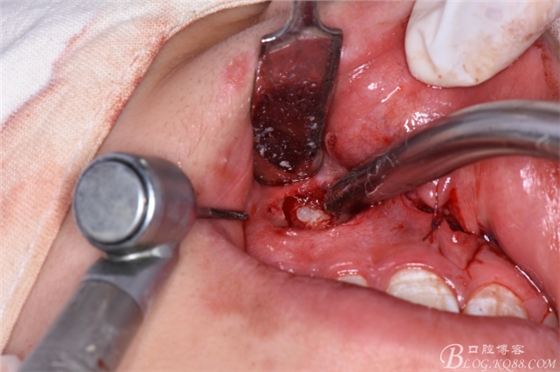 雙切口拔除鼻底埋伏多生牙