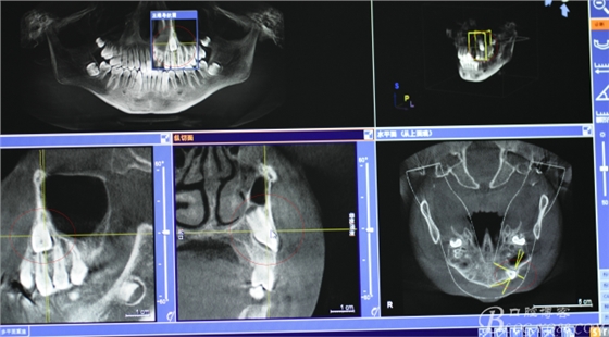 CBCT可以使拔牙更微創