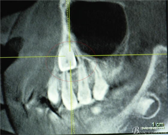 CBCT可以使拔牙更微創