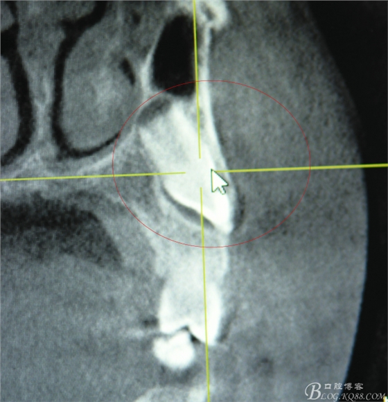CBCT可以使拔牙更微創