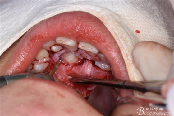 腭側開窗牽引雙側埋伏尖牙