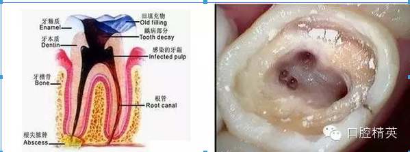 根管治療中開放的危害