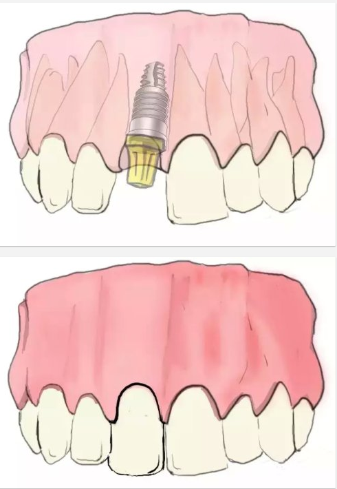 種植【最全的種植牙介紹】