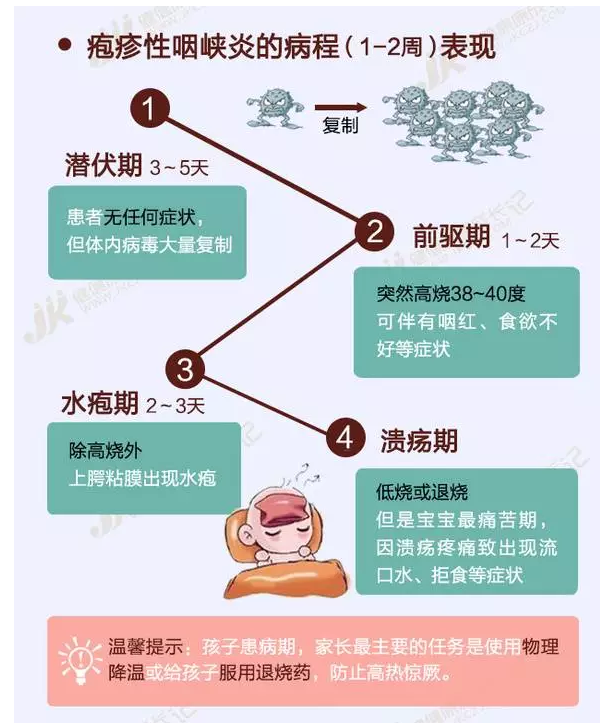 小兒皰疹性咽峽炎的治療和預防