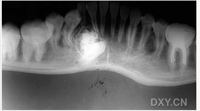 牙源性鈣化囊腫    牙瘤!