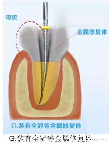 讓你知道根管測量受影響的原因