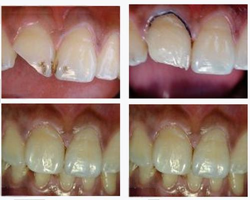 各類牙洞型樹脂修復
