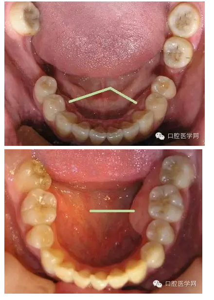 牙床骨質突起的原因和處理措施