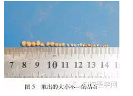 	下頜下靜脈畸形伴多發靜脈石誤診為涎石病1例