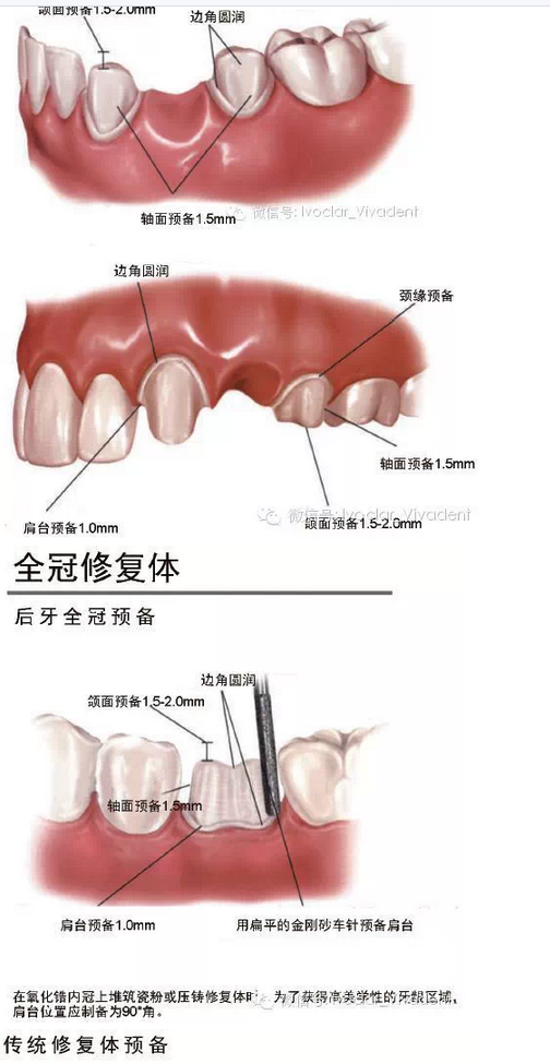 時常搞不清楚怎么備牙嗎？義獲嘉教您如何完美備牙