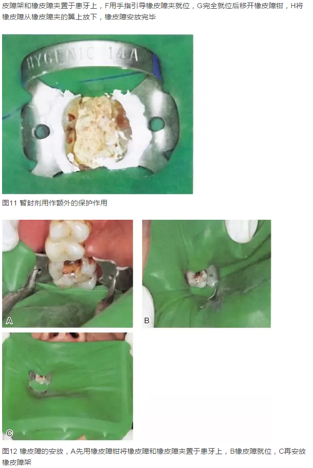 橡皮障隔離之單顆牙隔離方法——陳智教授