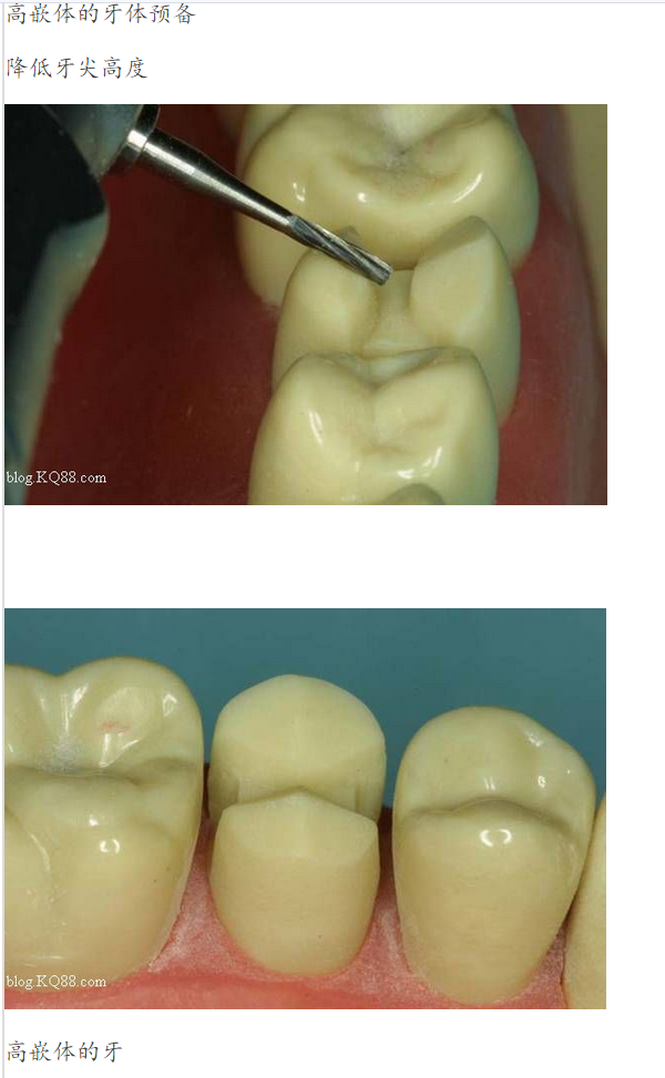 嵌體牙體預備方法