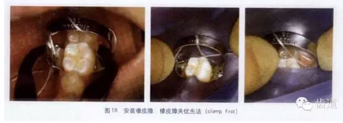 橡皮障的臨床運用大全