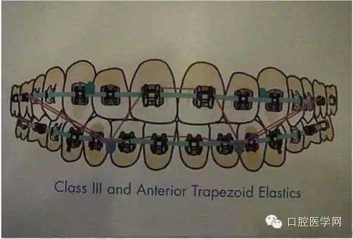 正畸damon system橡皮筋(elastics)掛法示意圖