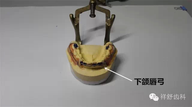 圖解Frankel-Ⅲ功能矯治器制作步驟