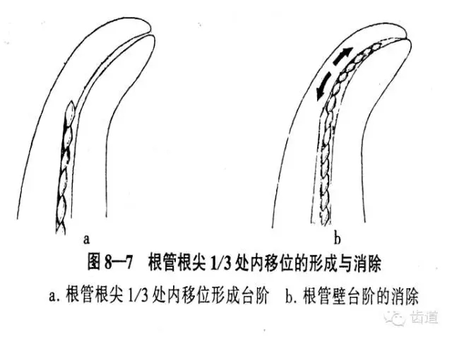 根管治療的并發癥及處理