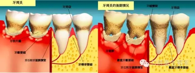 牙周炎的相關修復治療原則